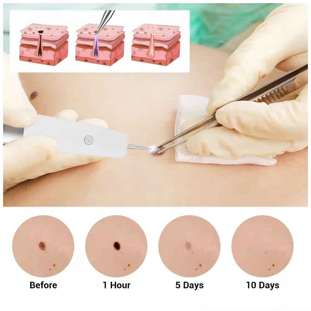 Penna Laser Plasma Estetica a 15 Livelli