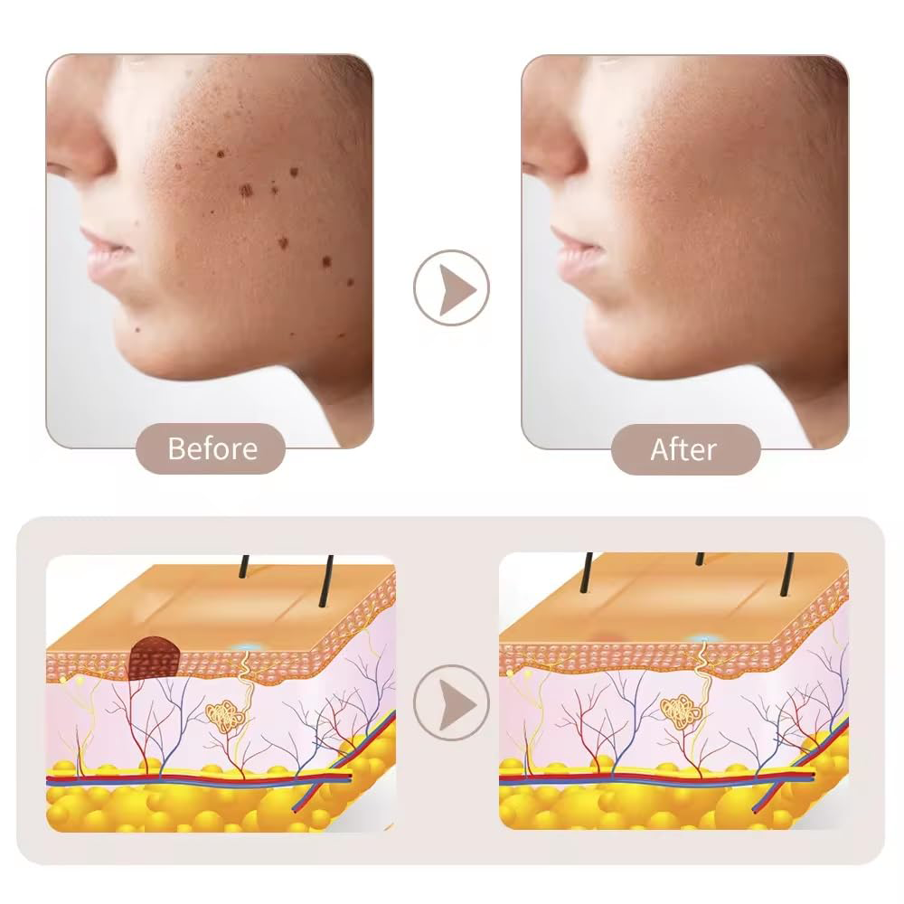 Penna Laser Plasma Estetica a 15 Livelli